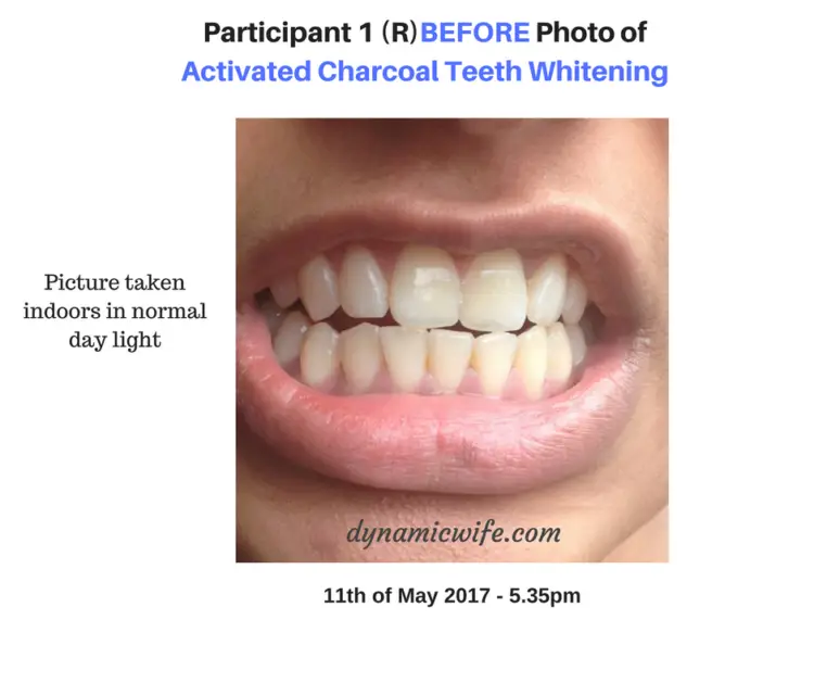 Activated Charcoal Teeth Whitening Experiment -2 REAL Before/After Pics