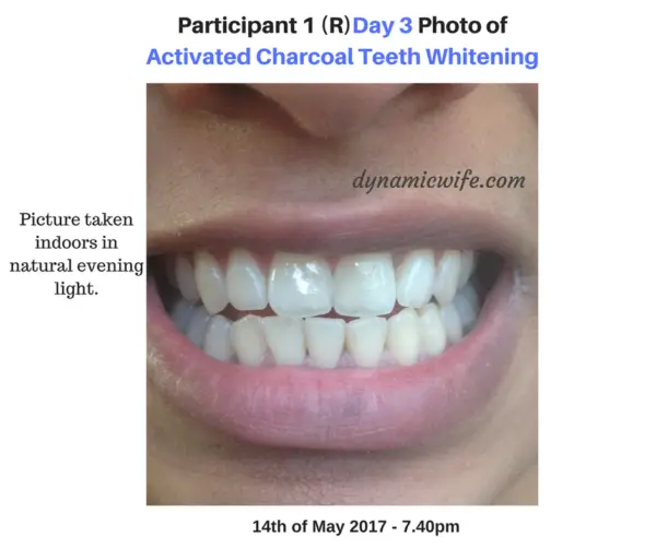 Activated Charcoal Teeth Whitening Experiment -2 REAL Before/After Pics