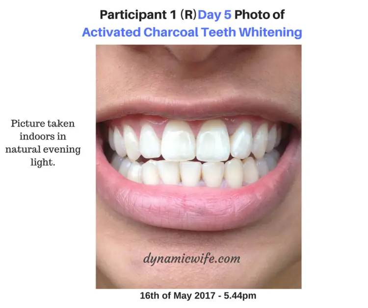 Activated Charcoal Teeth Whitening Experiment -2 Real Before After Pics