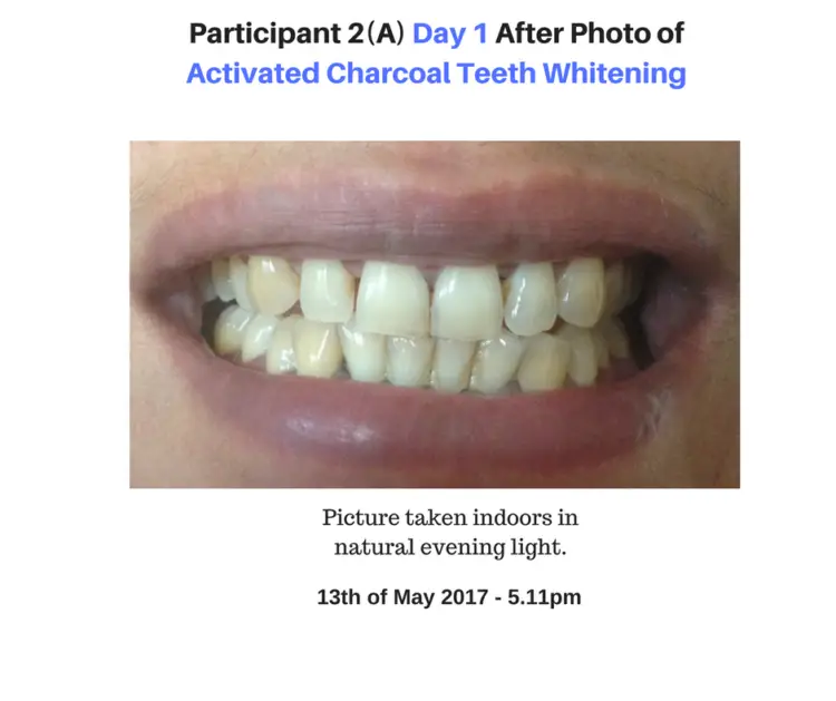 Activated Charcoal Teeth Whitening Experiment -2 REAL Before/After Pics